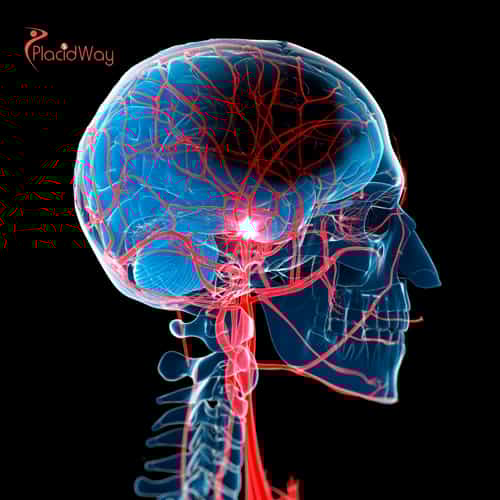 Stem Cell Therapy for Stroke Recovery in Mexico: The Complete Guide to Advanced Regenerative Treatment